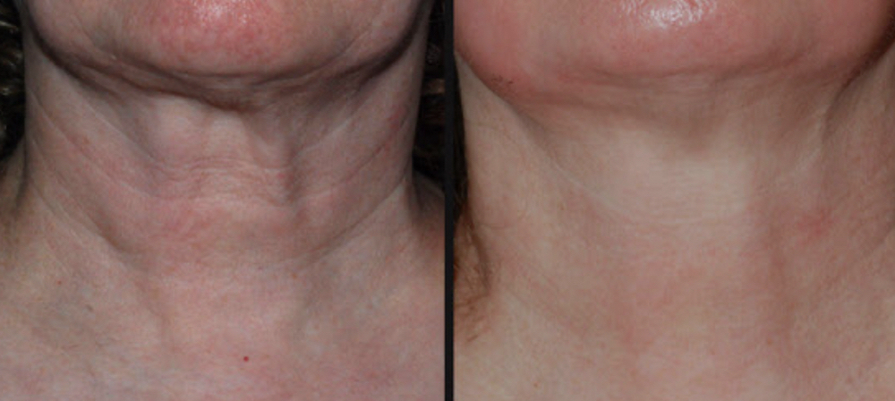 BB Glow Neck Tightening at Mjartistry in Manahawkin, NJ