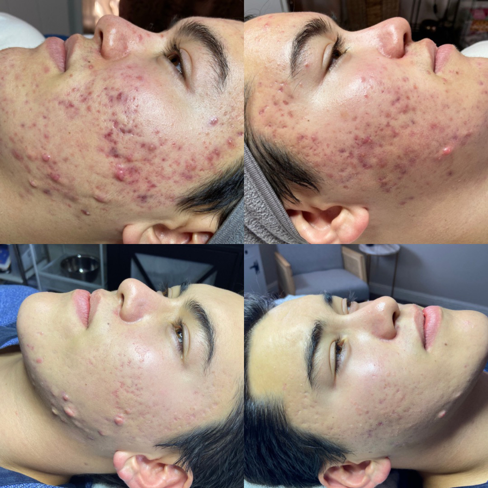 Deluxe Acne Treatment