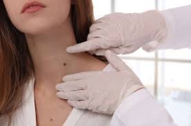 Skin Tag Removal