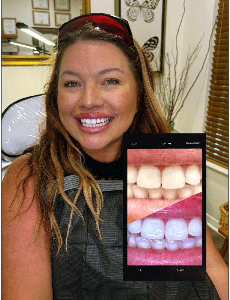 Professional Teeth Whitening
