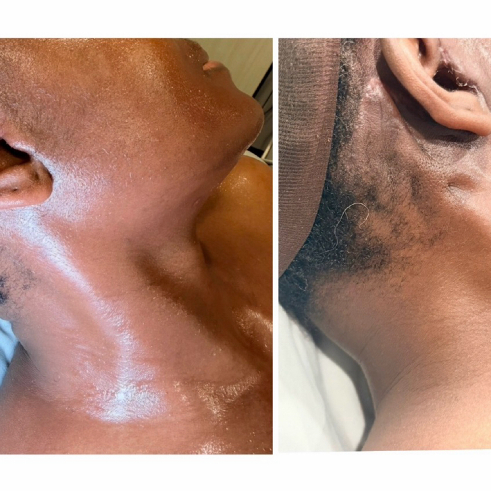 Facelift/Neck Lipo at Pro Lymphatics in Las Vegas, NV