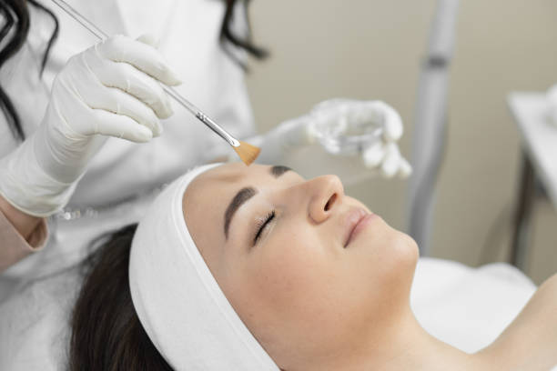 Chemical Peel