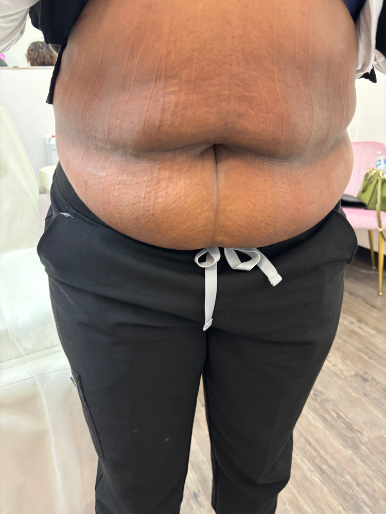 Body Sculpting