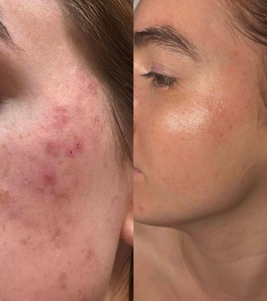 Rasberry Champangne Facial