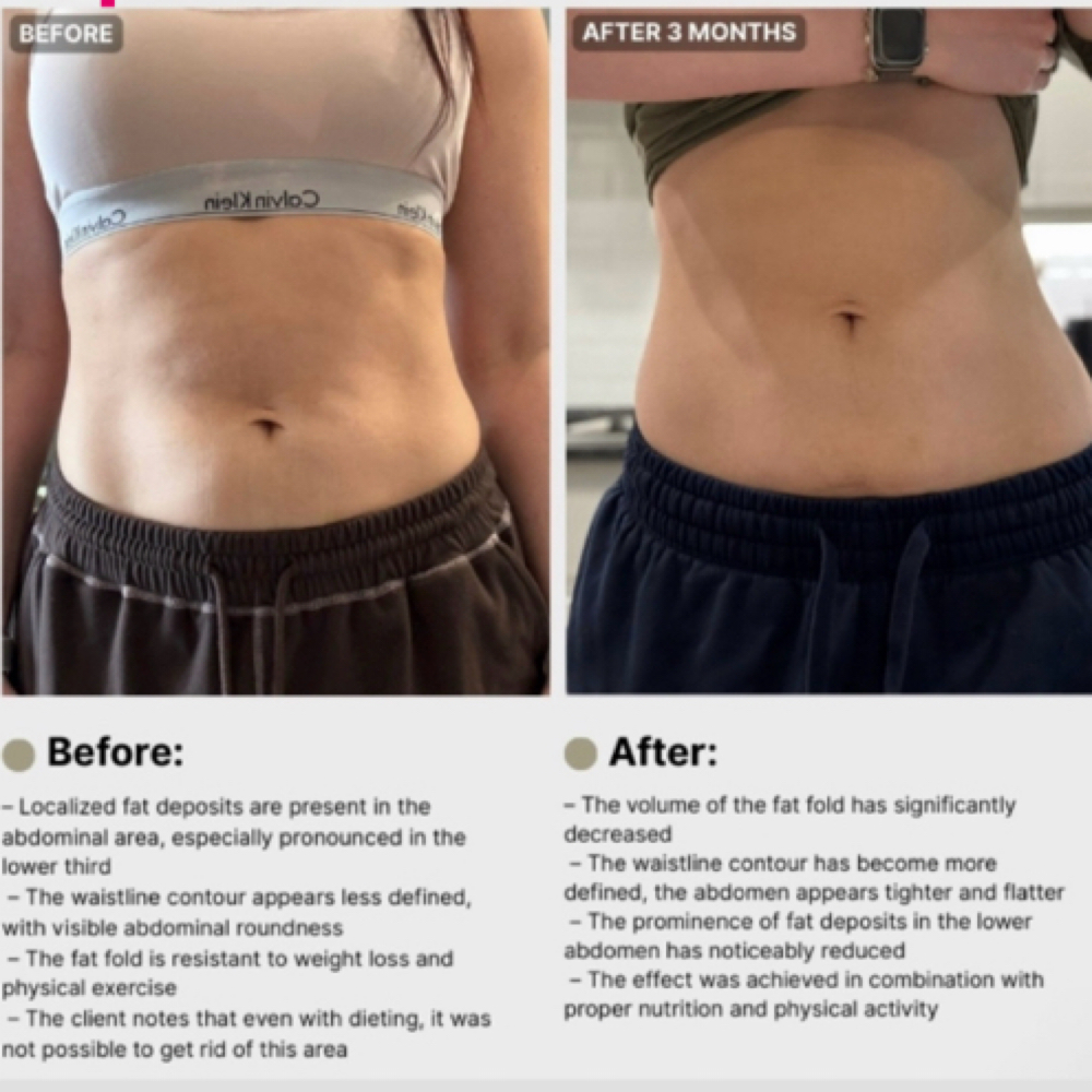 Kybella Fat Dissolving Shots at Flawless Spa & Beauty in Fort Worth, TX