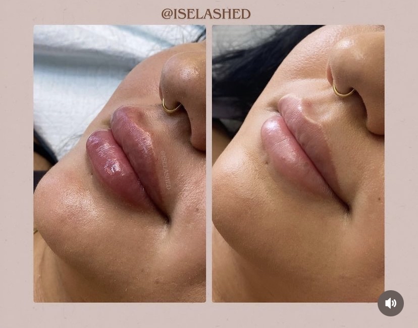 Lip Filler 1ml New Client ( Pen )