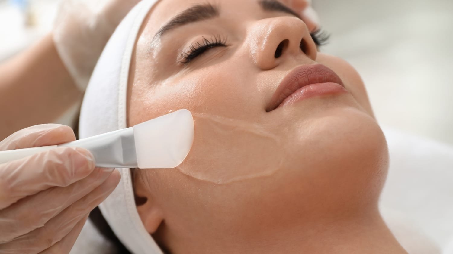 CHEMICAL PEEL