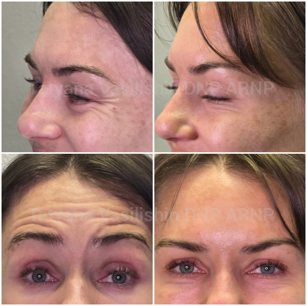 Anti-wrinkle Injectables