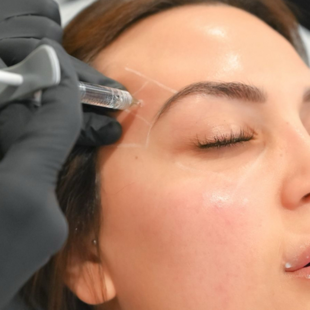 Temple Filler at beautybydeannette in San Antonio, TX