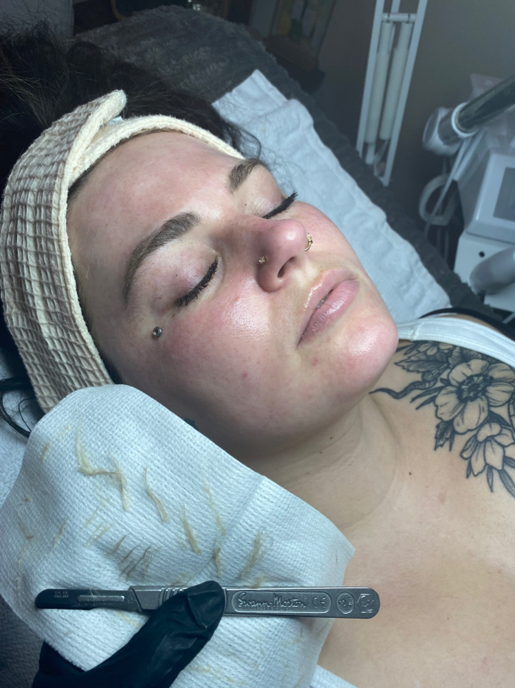 Dermaplaning Facial