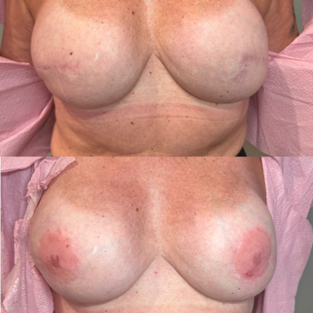 3D Areola Tattooing at Lyssie B. Artistry in Port Jervis, NY