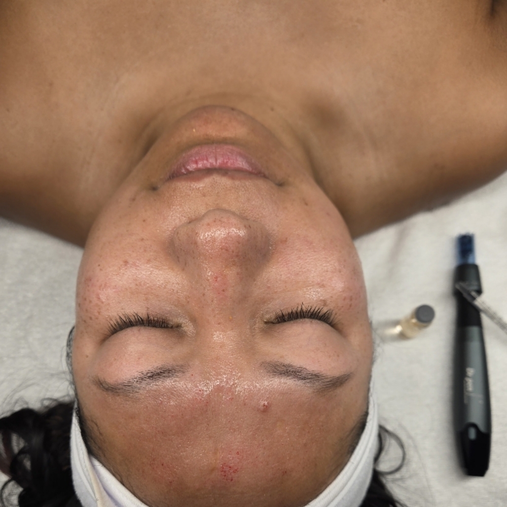 Microneedling at Midtown Esthetics in Raleigh, NC