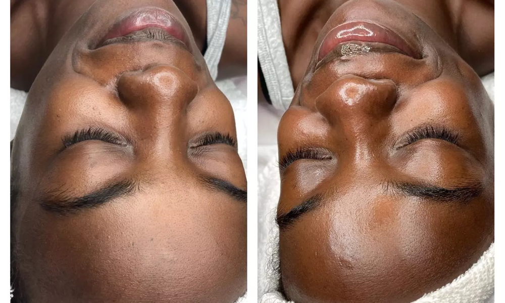 Dermaplaning Facial Treatment