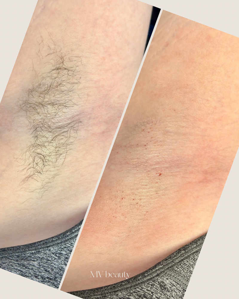 Under Arm at MV Beauty in Broken Arrow, OK