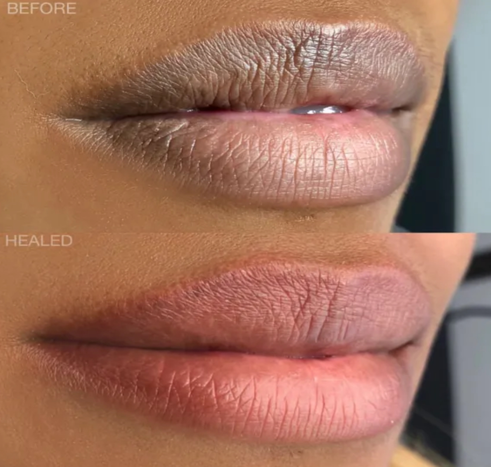 Dark Lip Correction (was $599)