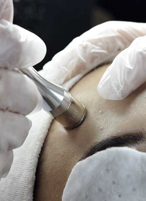 ADD ON - Microdermabrasion