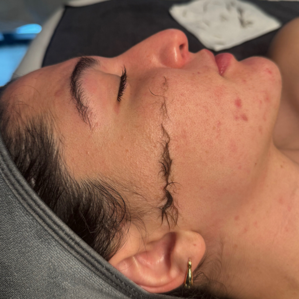 Dermaplane at Services By Kelsey | Esthetician in Beavercreek, OH