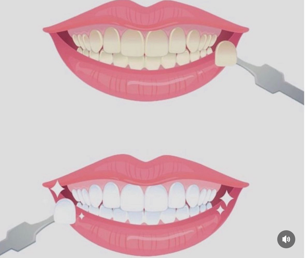 Advanced Teeth Whitening