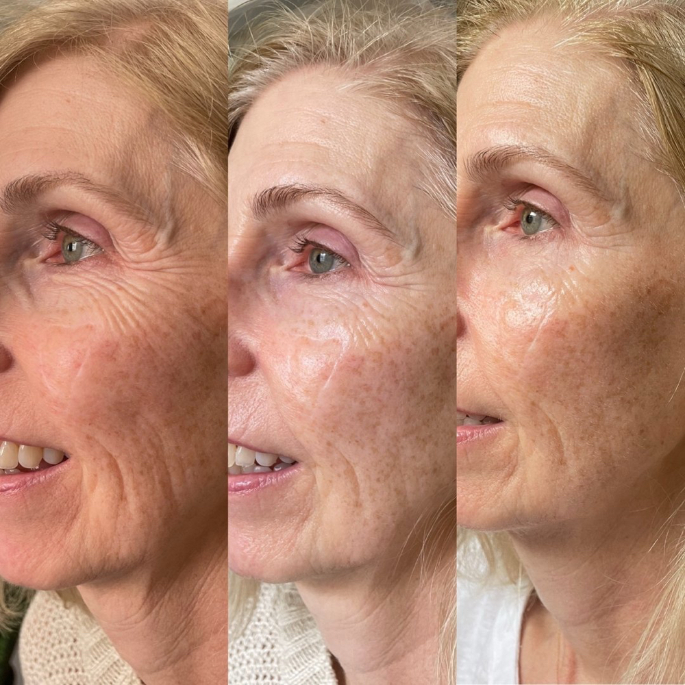 VTox Age Later Face Lift Facial