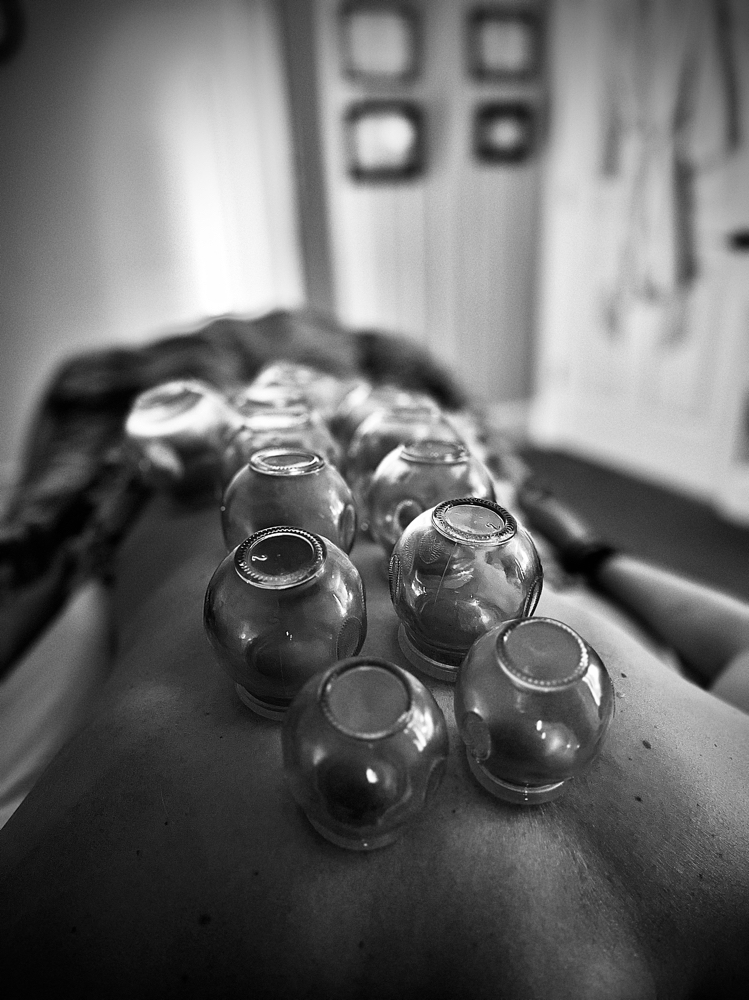 Cupping Therapy