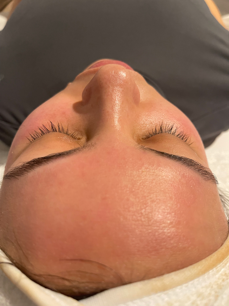 Chemical Peel