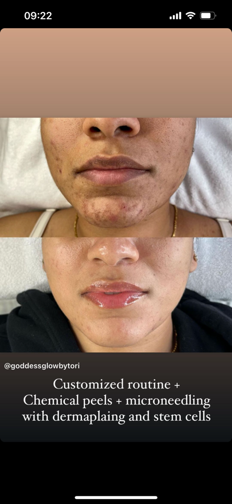Acne-clearing Facial at Moon Massages By Beauty Glam Spa in Ansonia, CT