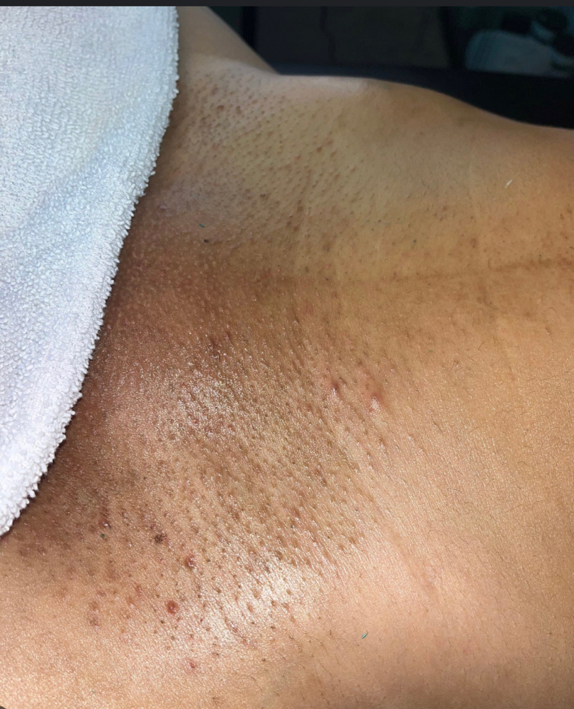 Brazilian Wax + Vajacial
