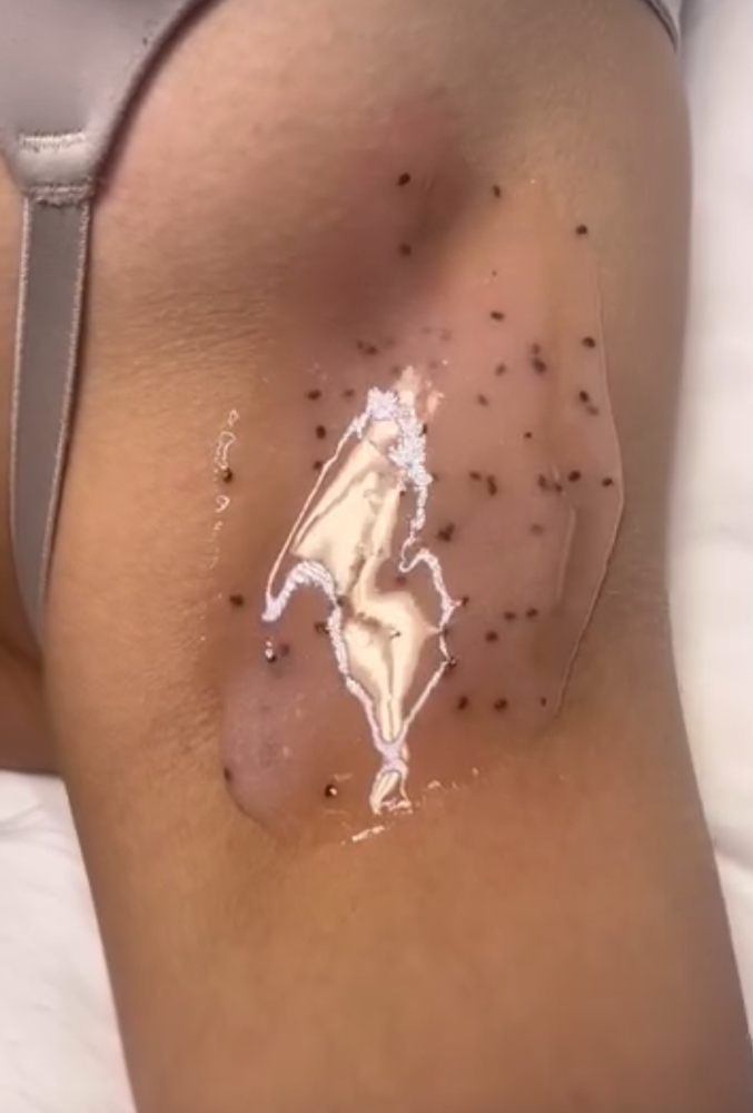 Underarm Microderm Facial