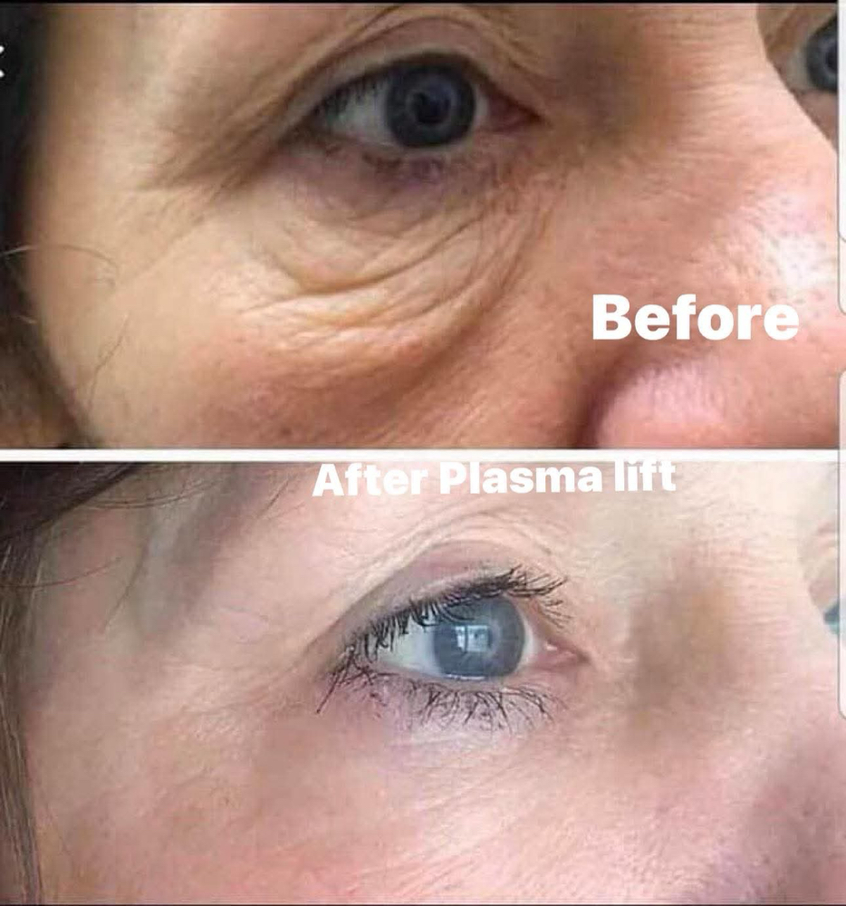 UNDER EYELID LIFT- COLD PLASMA