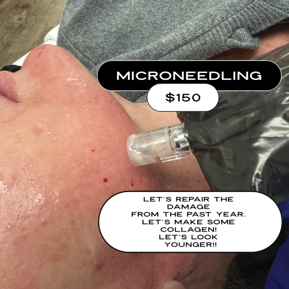 Microneedling Treatment at Plush Spa in Joplin, MO