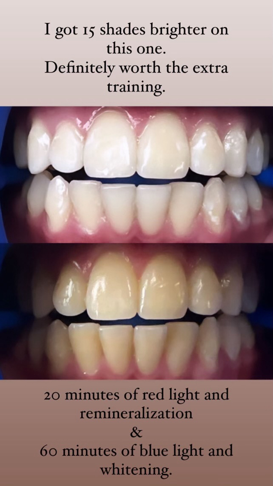 Teeth Whitening