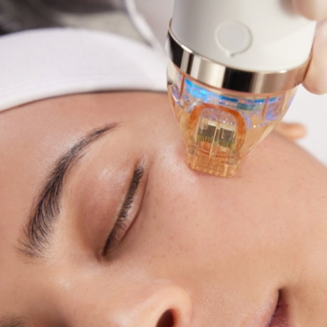 Microneedling Treatment