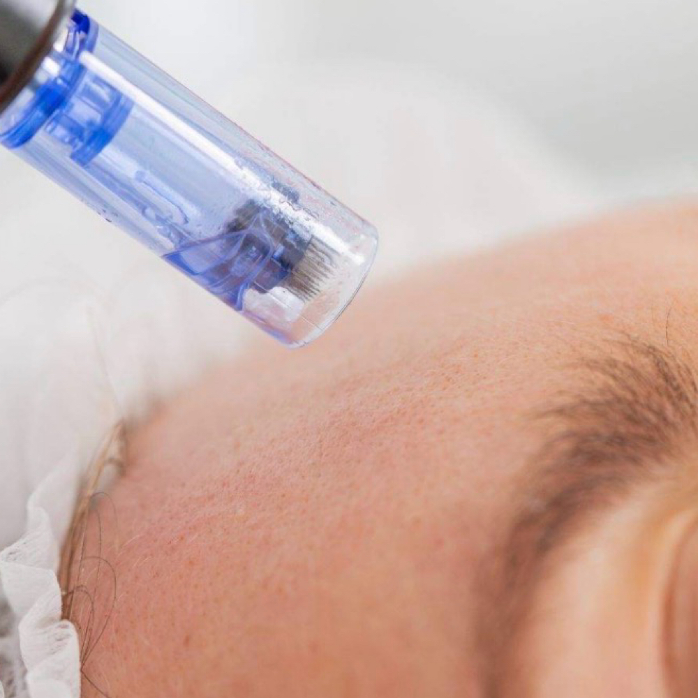 Microneedling at Beyond the Skin in North Chelmsford, MA