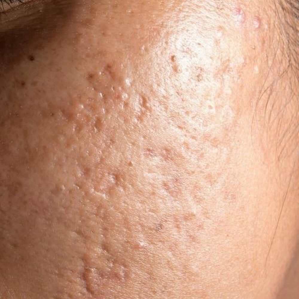 Acne Scar Treatment