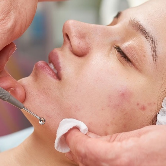Acne Facial at Aesthetica Organic Spa in Houston, TX