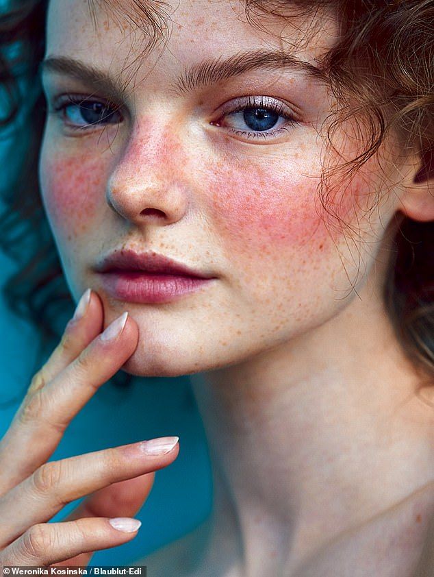 Rosacea Treatment