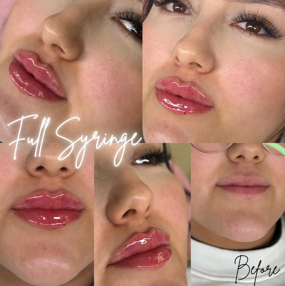 1ML Dermal Lip Filler💋💉 at BeautyHolic Aesthetics LLC in Lubbock, TX