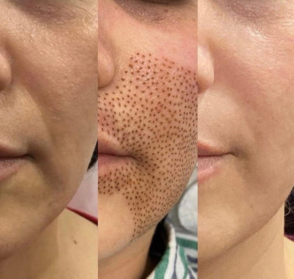 Smile Line& Lip Plasma Fibroblast