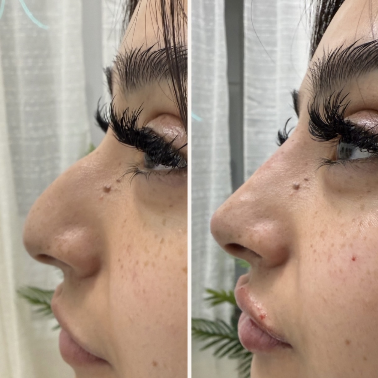 Liquid-Rhinoplasty 1 ML