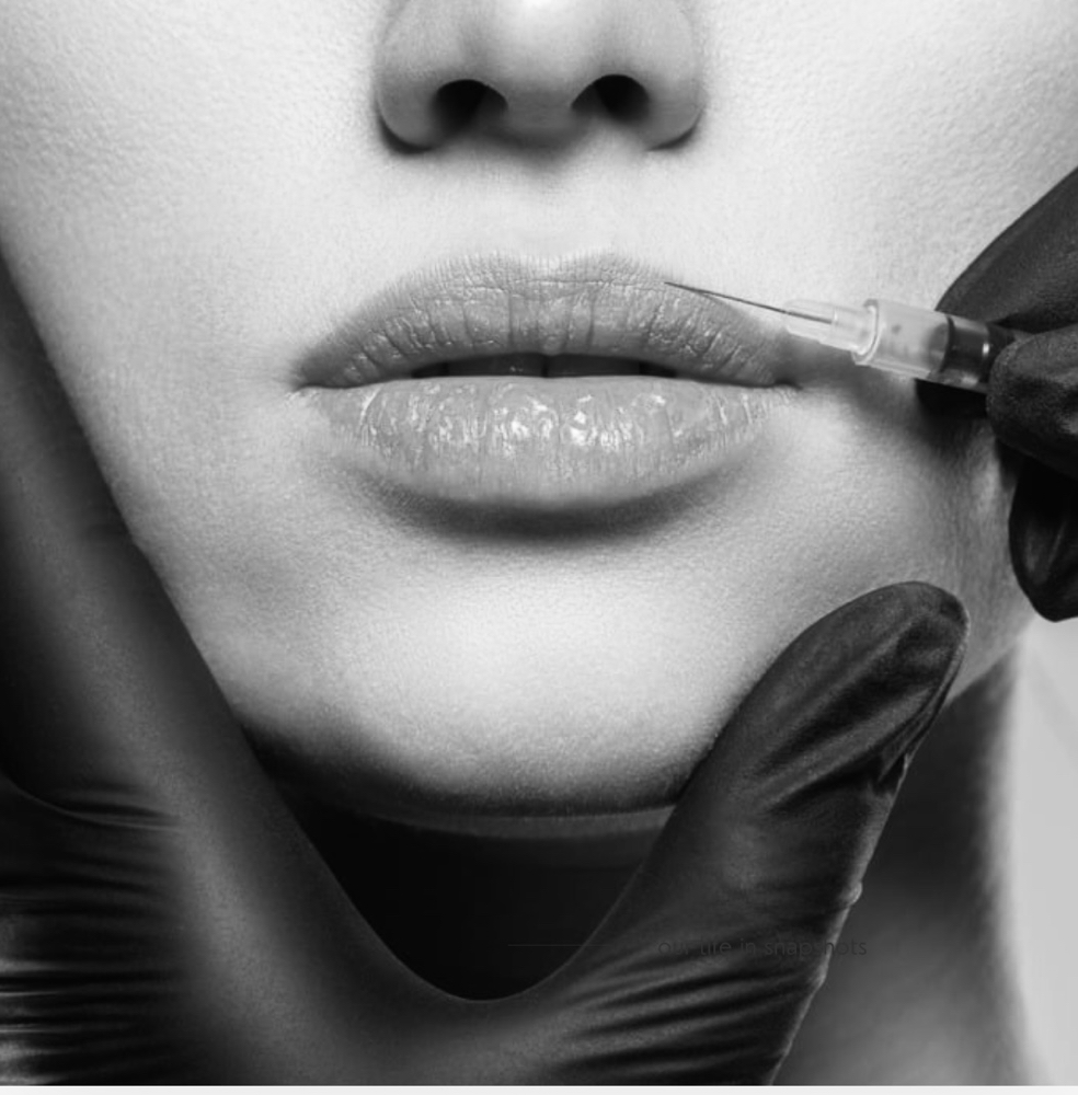 Filler (Juvederm/Restylane)