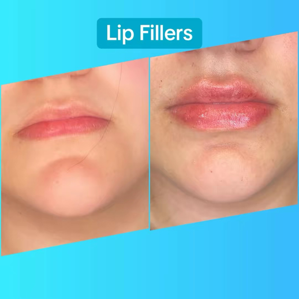 Vixen Lip Filler - 1 ML at 210 The Body Bar | San Antonio Lux Spray Tans & Body Sculpting in San Antonio, TX