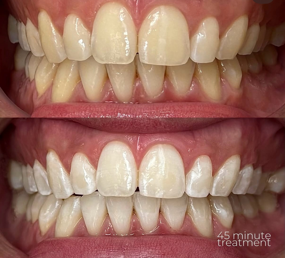 Teeth Whitening- 45 Minute Sessionn