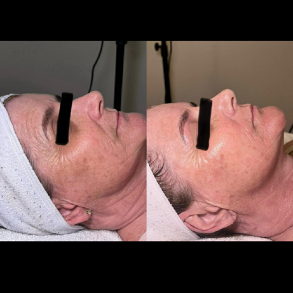 Switch 37+ treatment at Bare Beauty By Alexis in Bay Saint Louis, MS