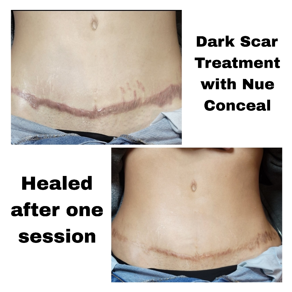 Scar Treatment Nue Conceal