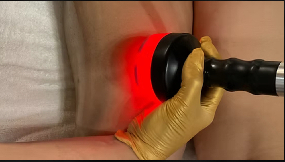 Vacuum RF Cellulite Treatment 10