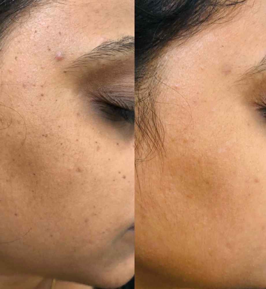 Skin Imperfection Follow Up