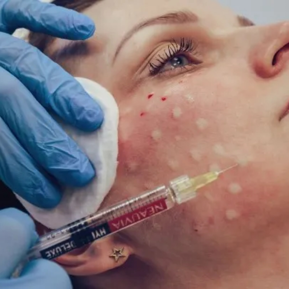 Hydra Deluxe 2 Syringes x 2.5 ml at Kelly Sorza Beauty Esthetic in San Jose, CA