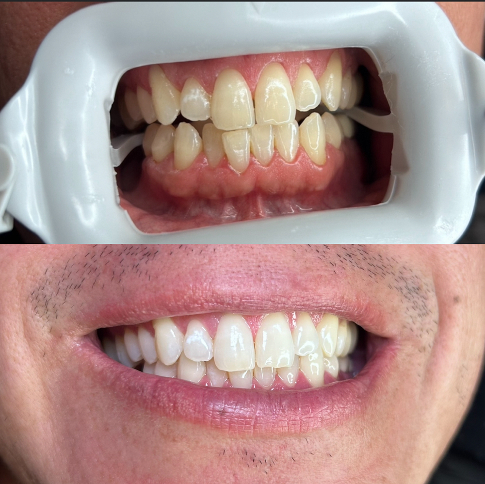 30 min Teeth Whitening *add on*