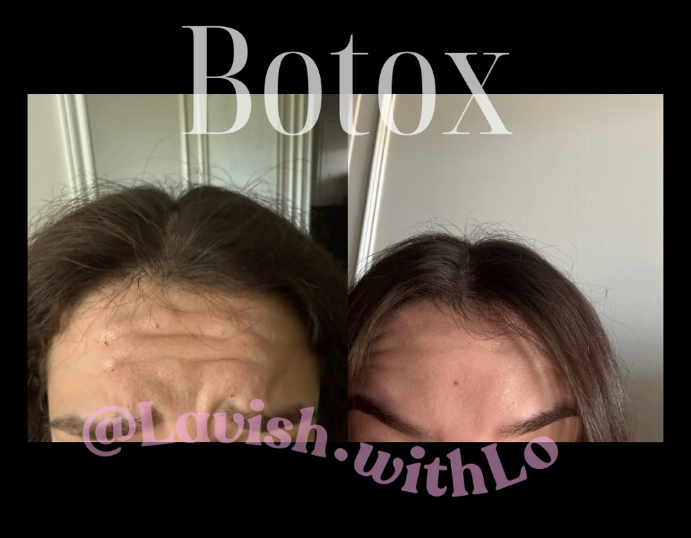 Frontalis / forehead at Lavish.withLo in Sunnyvale, TX