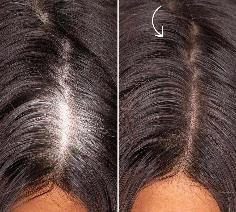 Root Retouch (Gray Coverage)